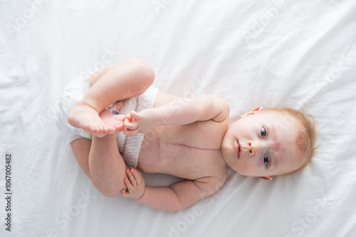 little girl with a scar from heart surgery