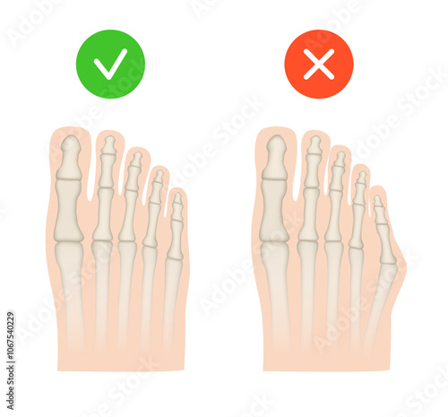 Taylor deformation. Valgus deformity of the little toe joint. Vector illustration.