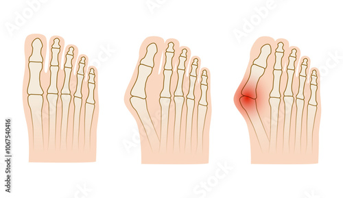 Hallux valgus. Valgus deformity of the big toe joint. Vector illustration.