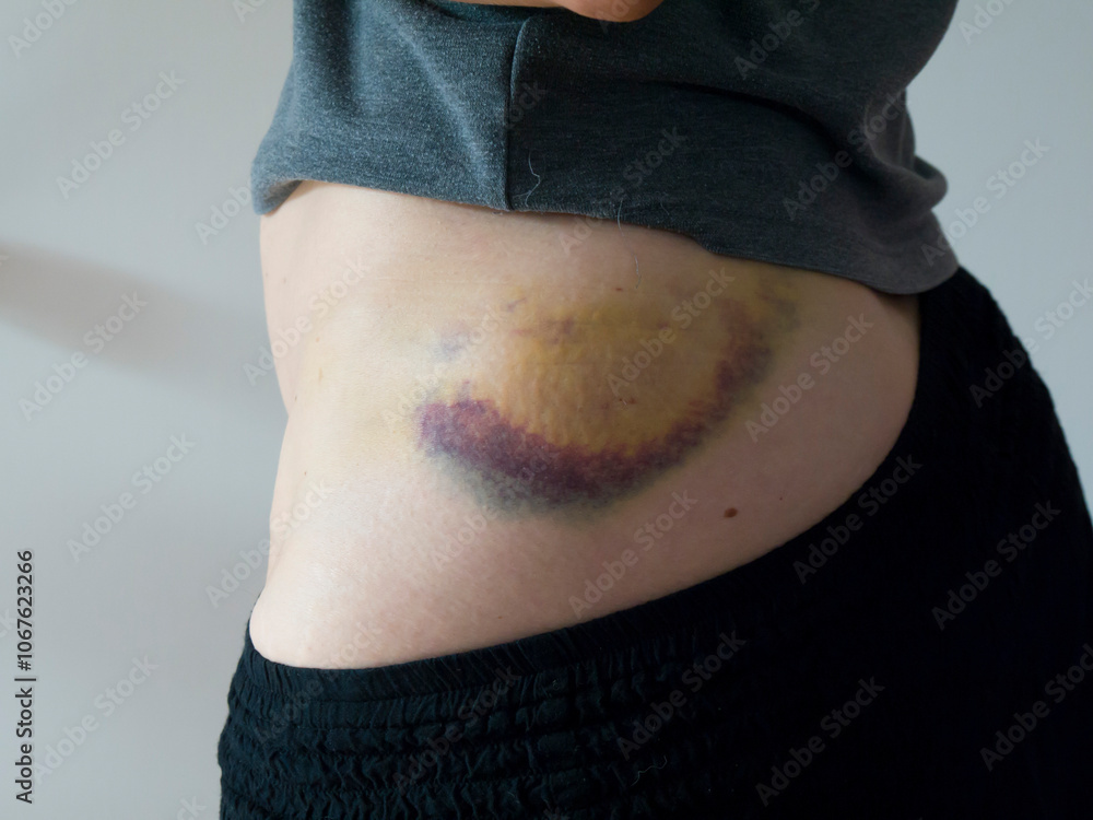 Woman injured bruised hip