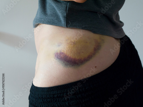 Obraz na płótnie Woman injured bruised hip w salonie
