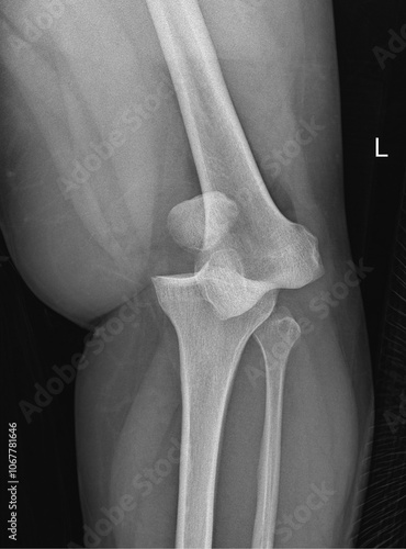 Cuadro en lienzo Knee Joint Dislocation Radiograph: Diagnostic X-Ray Imaging