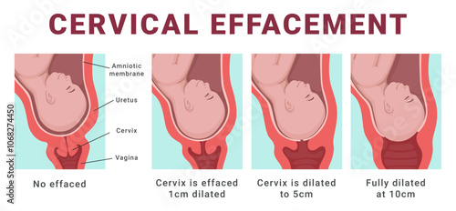 Cervical effacement human childbirth steps medical scheme poster vector flat illustration
