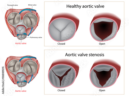 Aortic valve stenosis and Healthy aortic valve. Valvular heart disease. Anatomy heart 