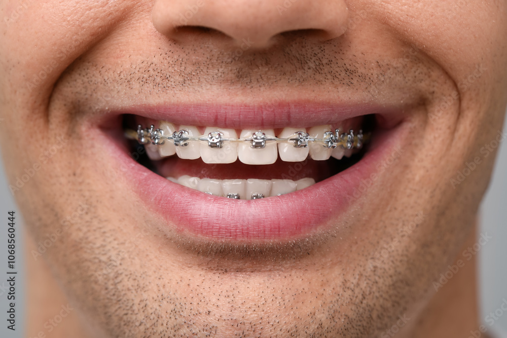Fototapeta premium Smiling man with dental braces on grey background, closeup