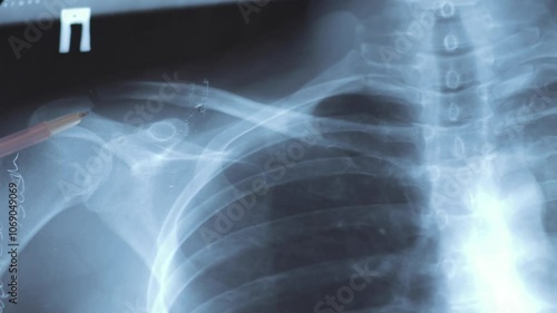 Doctor examining X-ray scan of  Dislocation of the acromial end of the clavicle.