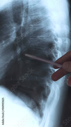 Vertical footage of Doctor examining fluorography, x-ray scan. Diagnosis of the disease humans lungs. Pneumonia, inflammatory condition of the lung. 