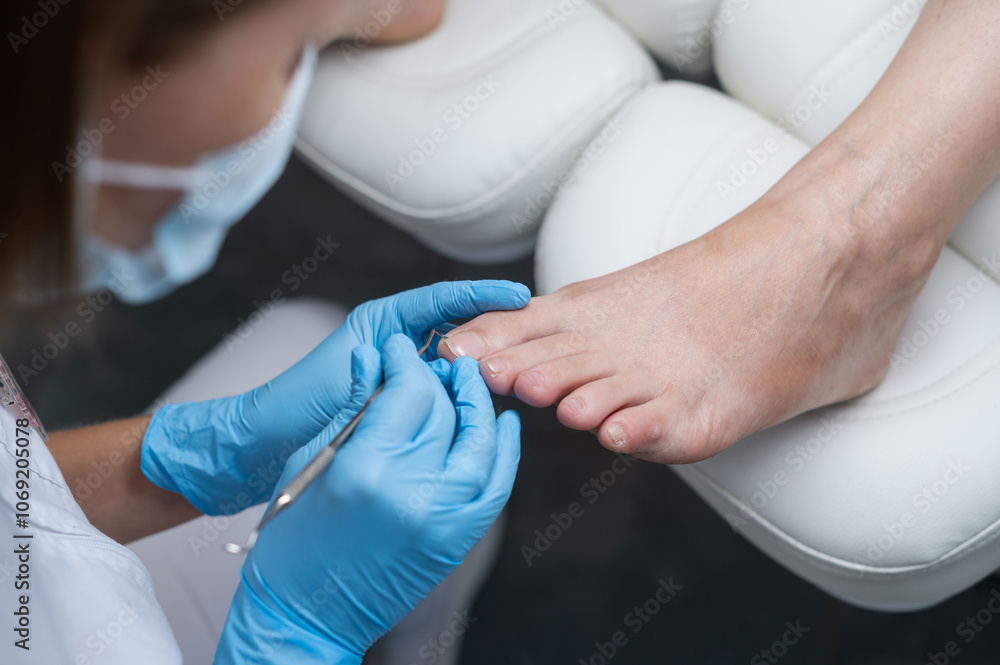 The podologist cleans the patient's nail using a curette tool. Patient on medical pedicure procedure, visiting podiatrist. Peeling feet. Foot treatment in SPA salon.Podiatry clinic The podologist cleans the patient's nail using a curette tool. Patient on medical pedicure procedure, visiting podiatrist. Peeling feet. Foot treatment in SPA salon.Podiatry clinic