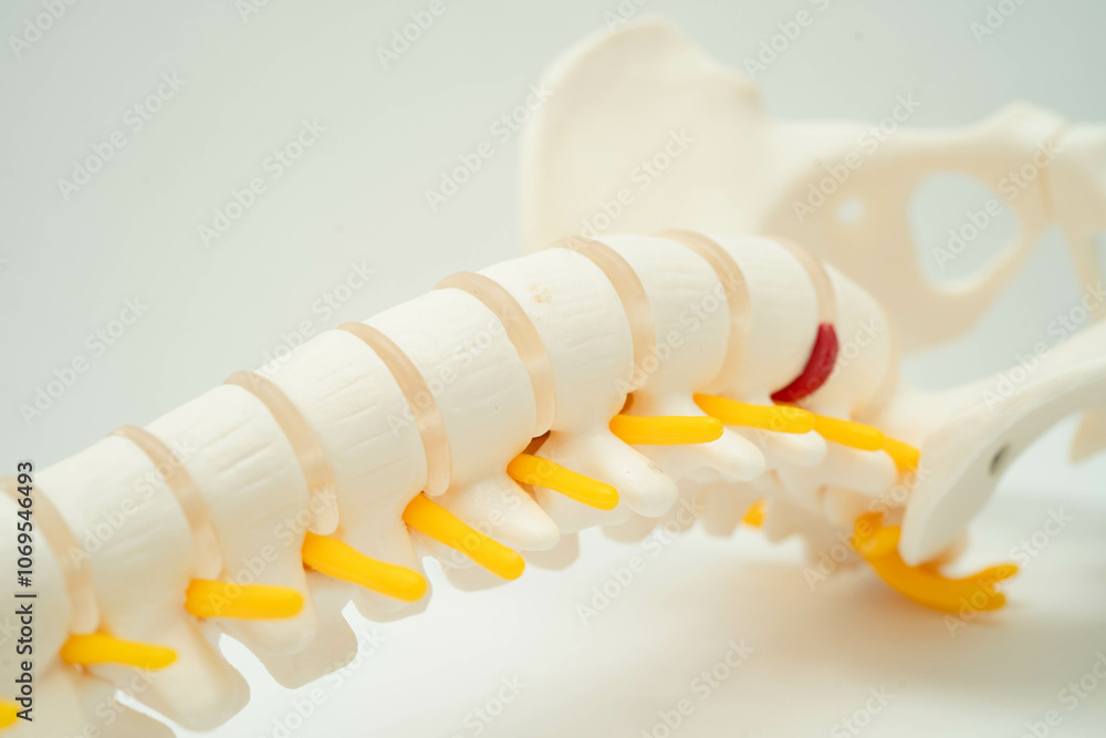 Naklejka premium Spinal nerve and bone, Lumbar spine displaced herniated disc fragment, Model for treatment medical in the orthopedic department.