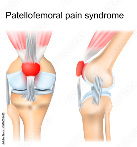 Patellofemoral pain syndrome. Knee joint anatomy