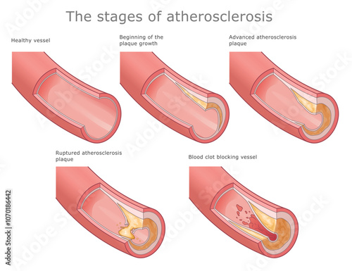 Stages of atherosclerosis medical diagram. Vector Illustration of several stages of atherosclerosis development.