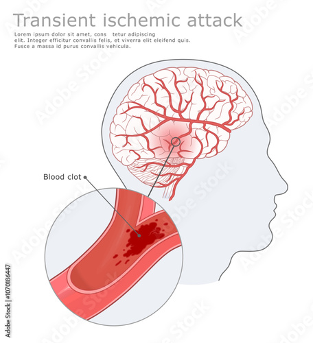 Transient ischemic attack medical illustration. Human brain and Transient ischemic attack. Vector medical illustration.