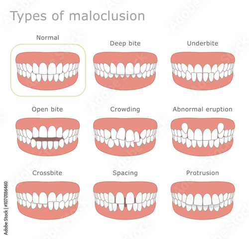 Types of malocclusion dental illustration. The illustration shows different types of human malocclusion.