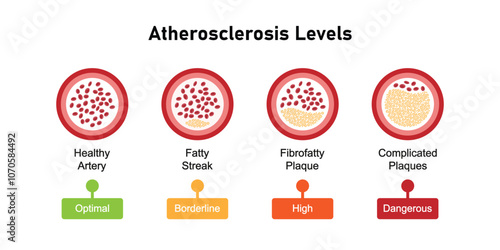 Atherosclerosis Levels Science Design. Vector Illustration.