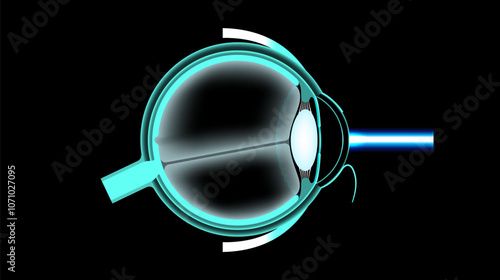 LASIK eye surgery