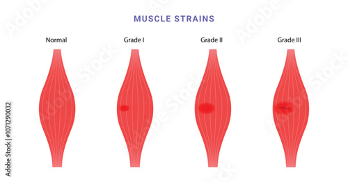 Muscle strain grading science diagram