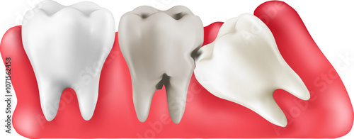 Illustration 3d vector realistic of wisdom tooth under gum cause of pain and lean on other teeth cause of tooth decay. Concept of pain in mouth, toothache, Mesh gradient wes used