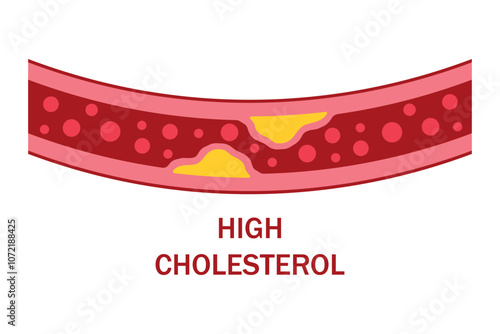 High blood cholesterol colorful icon with a arteriosclerosis risk. Clogged artery. Concept of high cholesterol and unhealthy lifestyle, fast food. thrombosis microvascular disease. Vector illustration