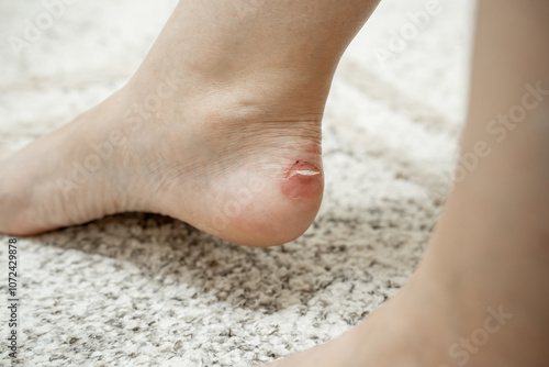 Close-up callus on a woman's ankle caused by wearing the wrong shoes