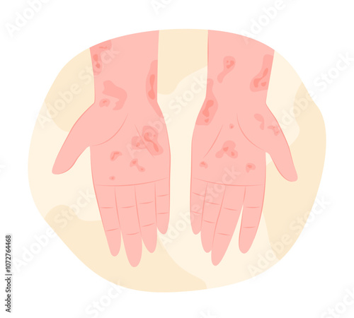 Eczema or Skin Rashes on Human Hands for Dermatology Concept Illustration