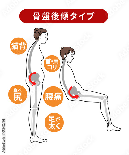 骨盤が後傾すると体にもたらす影響と骨の横から図