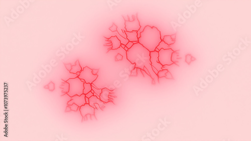 A port-wine stain or naevus flammeus is a vascular birthmark consisting of superficial and deep dilated capillaries in the skin which produce a reddish to purplish discolouration of the skin.