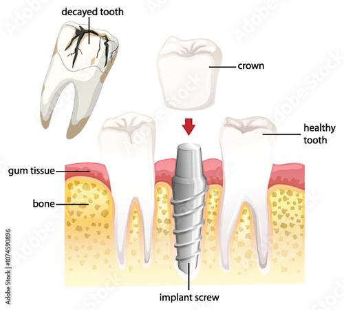 Dental Implant Procedure Illustration