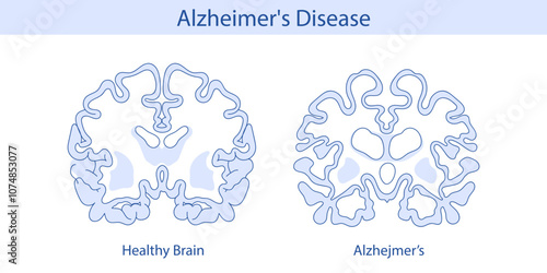 Healthy brain and brain with Alzheimer's disease. Hand drawn illustration.