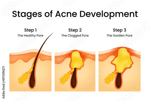 Stages of the Acne Development