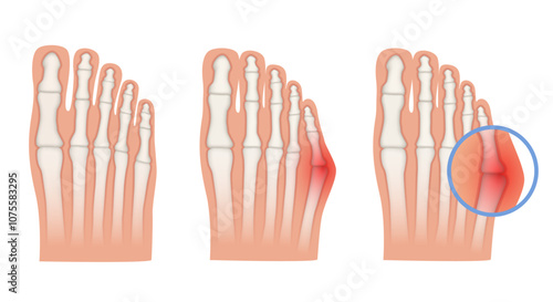 Taylor deformation. Valgus deformity of the little toe joint. Vector illustration.