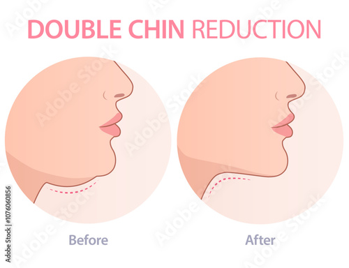 Vector illustration of a double. chin correction. Can be used for advertising purpose in cosmetology and aesthetic medicine. 