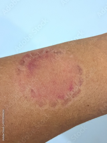zombie bite on hand