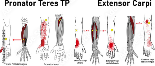 Myofascial Trigger Point, Pronator Teres TP, Extensor carpi