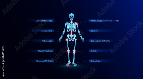 Human skeletal anatomy on dark background. Bone disease infographic Osteoporosis Rheumatoid arthritis Herniated disc Cervical Osteoporosis. For medical science work. Vector EPS10.