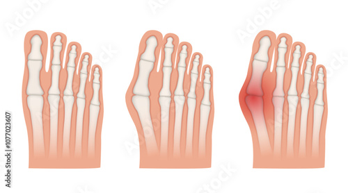 Hallux valgus. Valgus deformity of the big toe joint. Vector illustration.