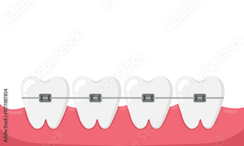 Installation of braces on teeth, straightening of crooked bites. Vector illustration