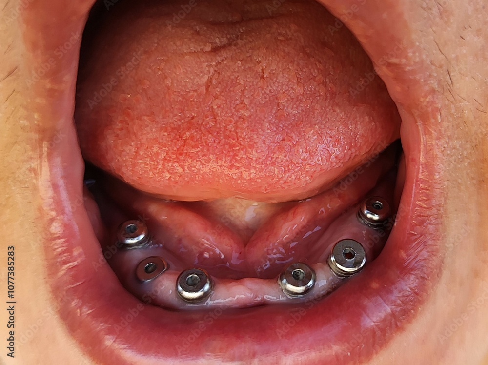 Obraz premium Dental implants, all in six, dental ceramic restoration, 19.