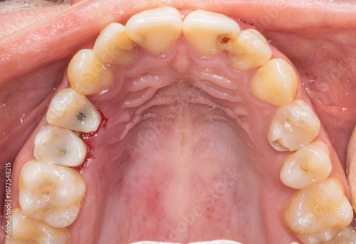 Occlusal view of a complete upper maxillary arch with restored teeth. Premolar crowns filled with resin composite and metallic post sealed on the root canal and dental caries on the incisors.