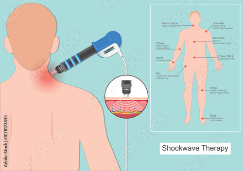 Extracorporeal Shock Wave Therapy (ESWT for short).