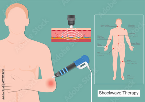 Shockwave therapy for tennis elbow (lateral epicondylitis)
