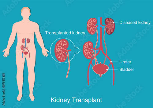 Kidney transplant is a surgery to place a healthy kidney.