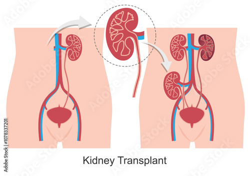 Kidney transplant is a surgery done to replace a diseased or injured kidney .