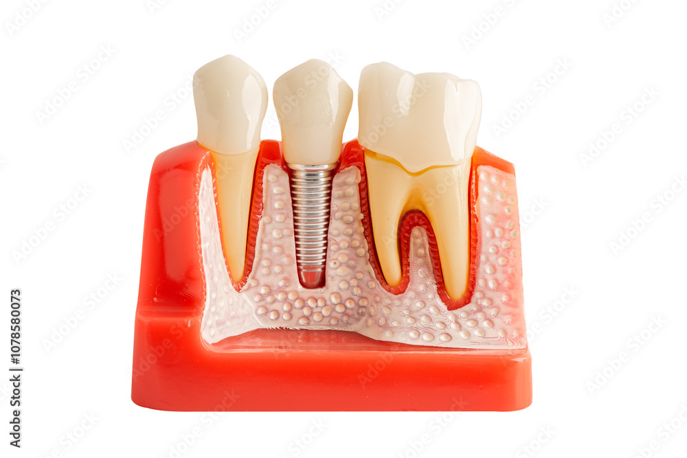 Obraz premium Dental implant, artificial tooth roots into jaw isolated on white background with clipping path.