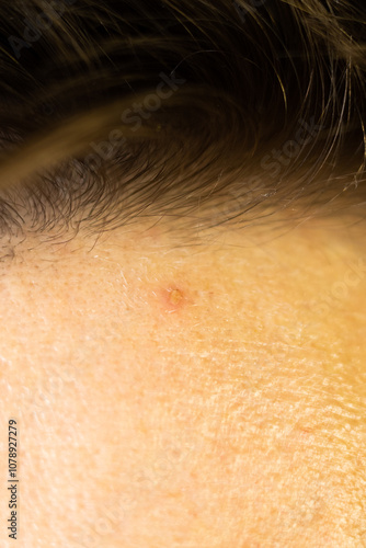 A pimple on a man's forehead. Acne on skin. Close up.