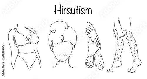 Hirsutism