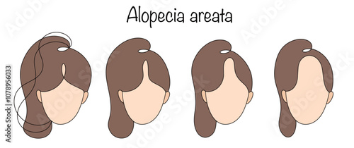Alopecia areata