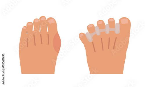 Infographic for feet health. Tight toes before, waring toe spacers, natural foot anatomy.