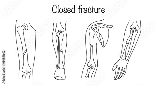 Closed fracture