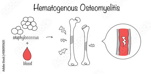 Hematogenous Osteomyelitis