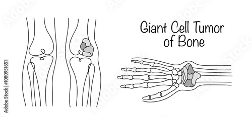 Giant Cell Tumor of Bone